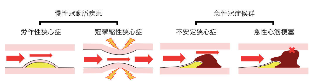 心筋梗塞、不安定狭心症