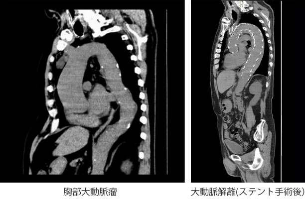 胸部⼤動脈瘤、⼤動脈解離(ステント⼿術後)