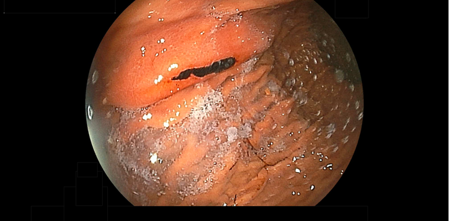 胃潰瘍・十二指腸潰瘍