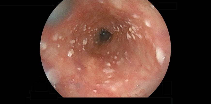 食道カンジダ症